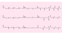 Anterior Wall Myocardial Infarction: Complete ECG Recognition and Emergency Management Guide