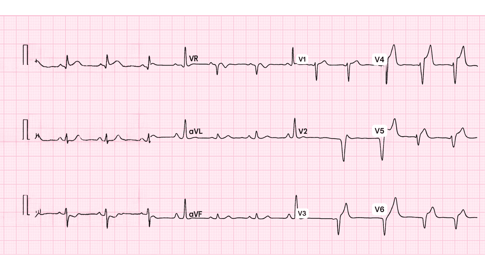 Anterior Wall Myocardial Infarction: Complete ECG Recognition and Emergency Management Guide