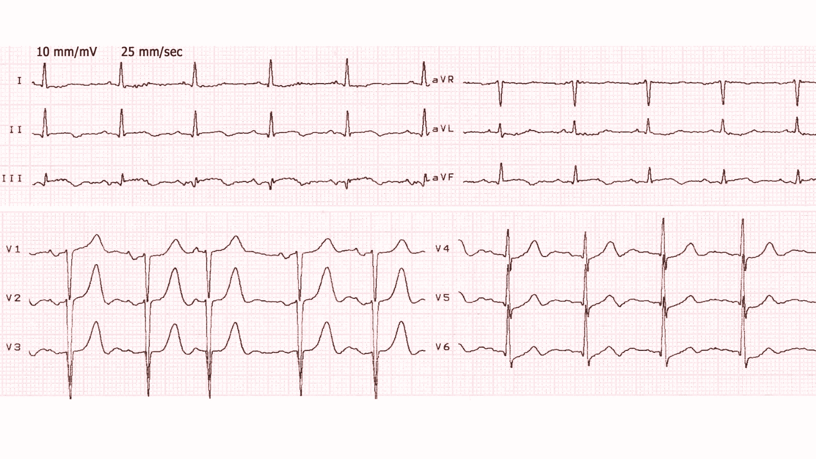 Anterolateral Myocardial Infarction: Advanced ECG Patterns and Clinical Pearls