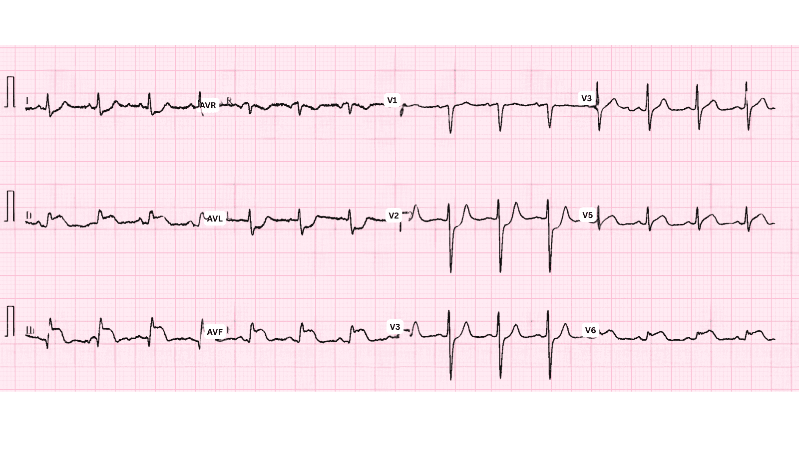Inferior Wall Myocardial Infarction: Complete ECG Recognition and Emergency Management Guide
