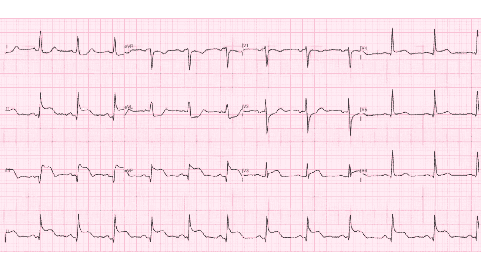 Inferior Wall Myocardial Infarction: Advanced ECG Patterns and Clinical Pearls