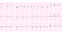 Anterior Wall Myocardial Infarction (AWMI): Advanced ECG Recognition and Emergency Management