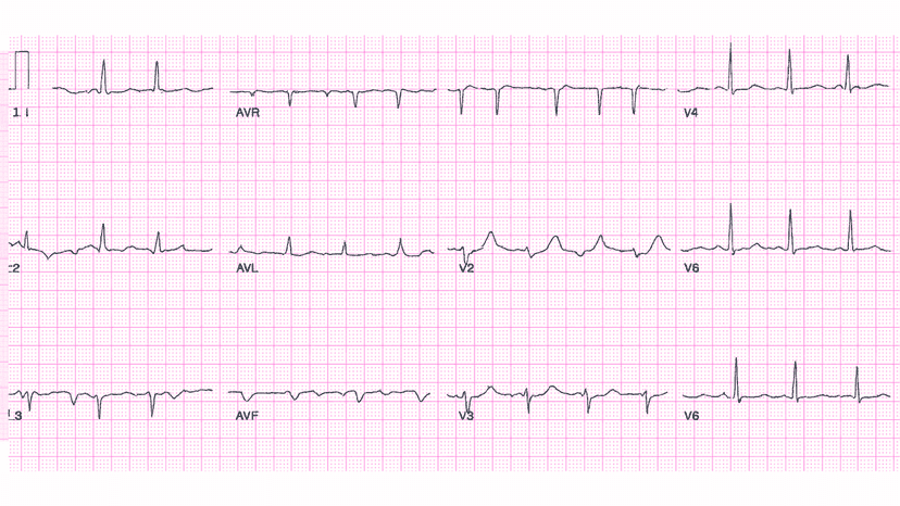 Anterior Wall Myocardial Infarction (AWMI): Advanced ECG Recognition and Emergency Management