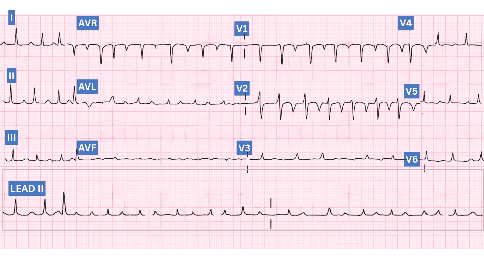 Cardiac Tamponade: Advanced ECG Recognition and Emergency Management