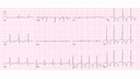 Dilated Cardiomyopathy with Global T Wave Inversion: Advanced ECG Recognition and Emergency Management