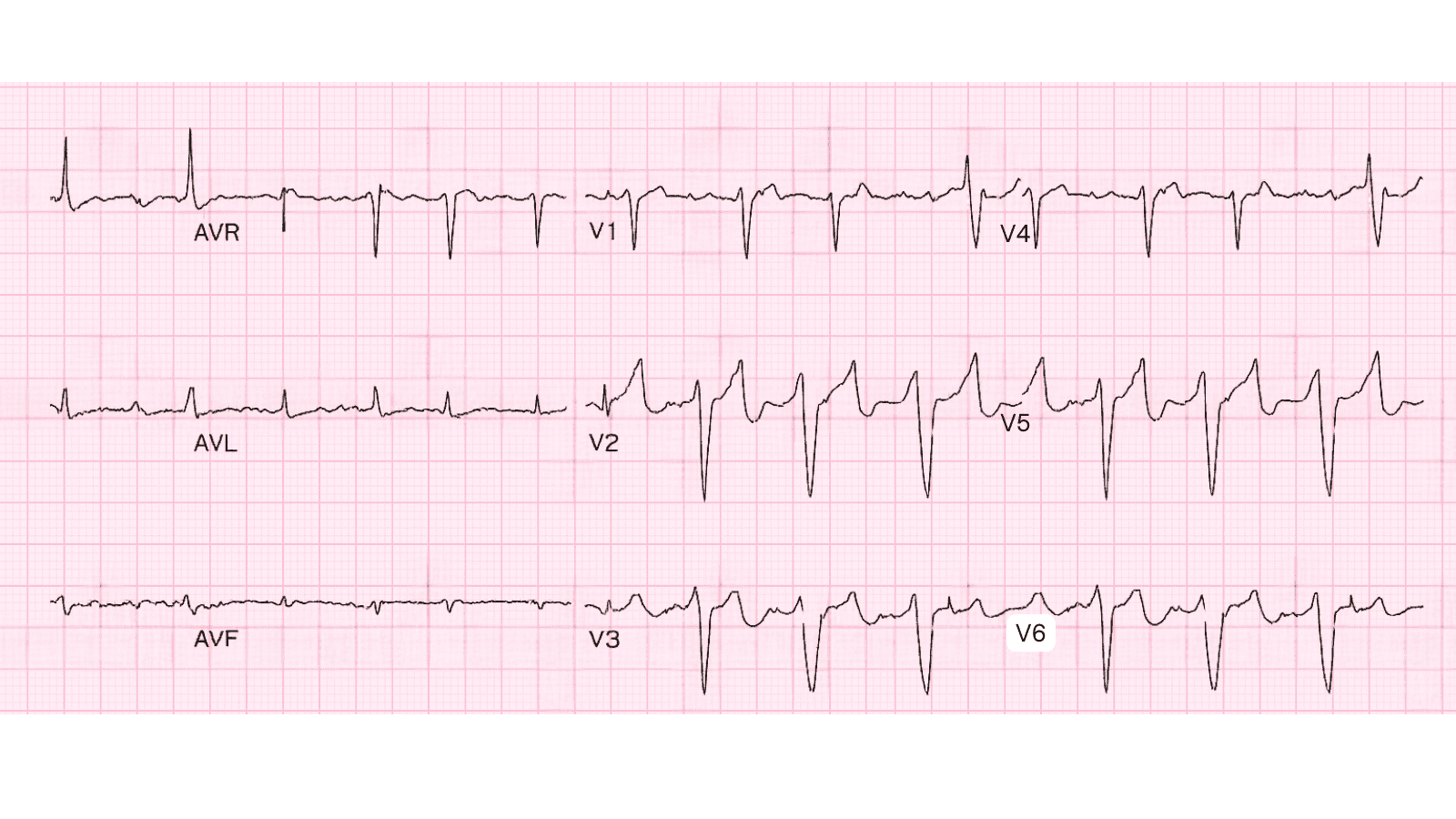 Early Repolarization: Advanced ECG Recognition and Emergency Management