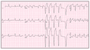 Monomorphic Ventricular Tachycardia: Advanced ECG Recognition and Emergency Management
