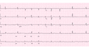 Second Degree AV Block Mobitz Type I (Wenckebach): Advanced ECG Recognition and Emergency Management