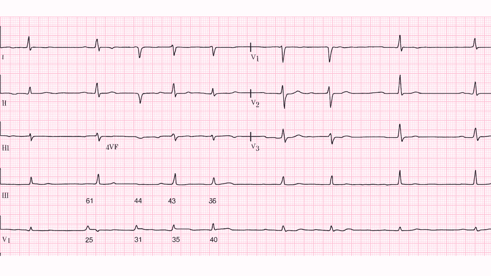 Second Degree AV Block Mobitz Type I (Wenckebach): Advanced ECG Recognition and Emergency Management