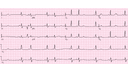 Second Degree AV Block Mobitz Type II: Advanced ECG Recognition and Emergency Management