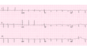 Wandering Atrial Pacemaker (WAP): Advanced ECG Recognition and Emergency Management