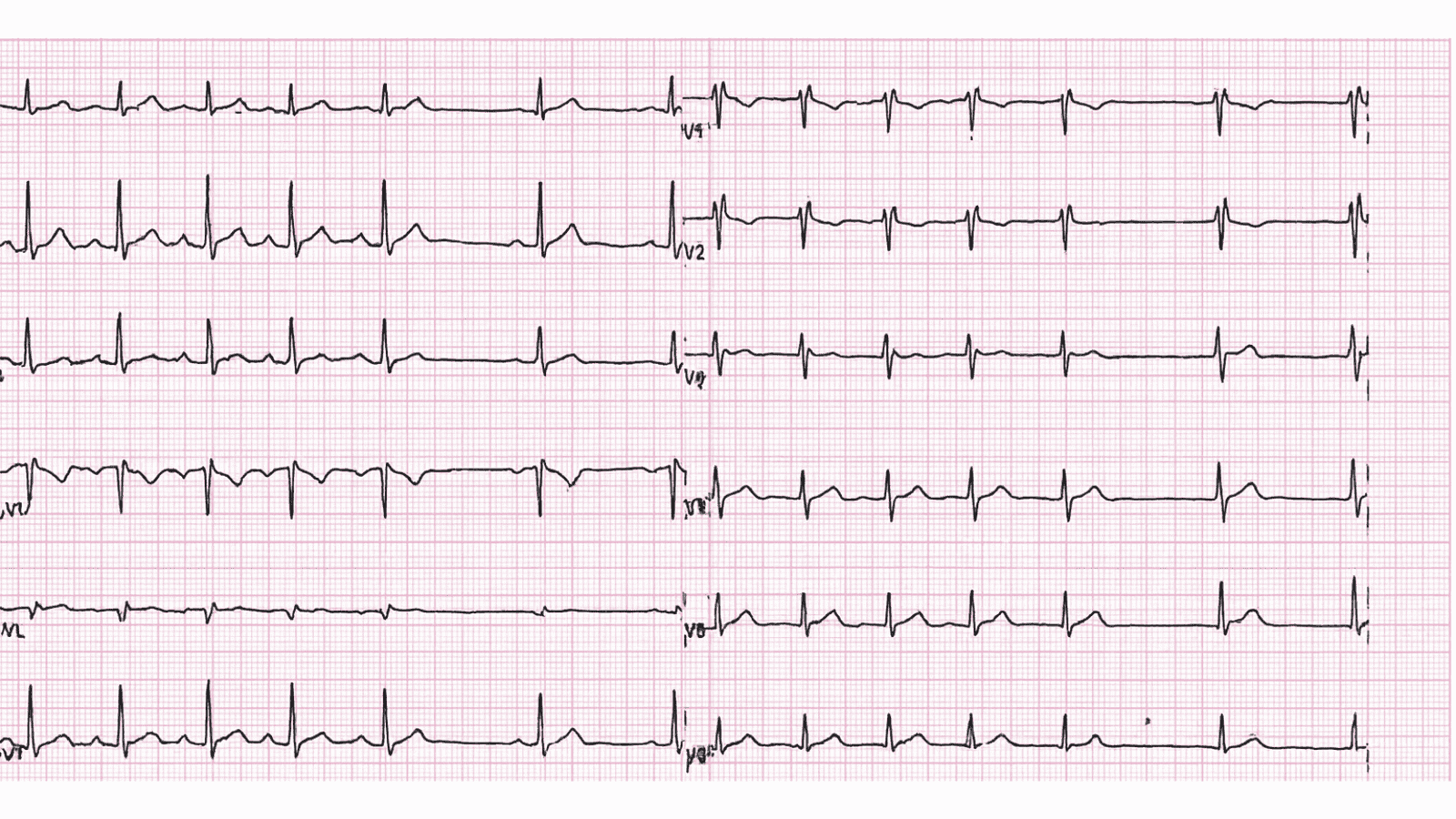 Incomplete Right Bundle Branch Block: Advanced ECG Recognition and Emergency Management