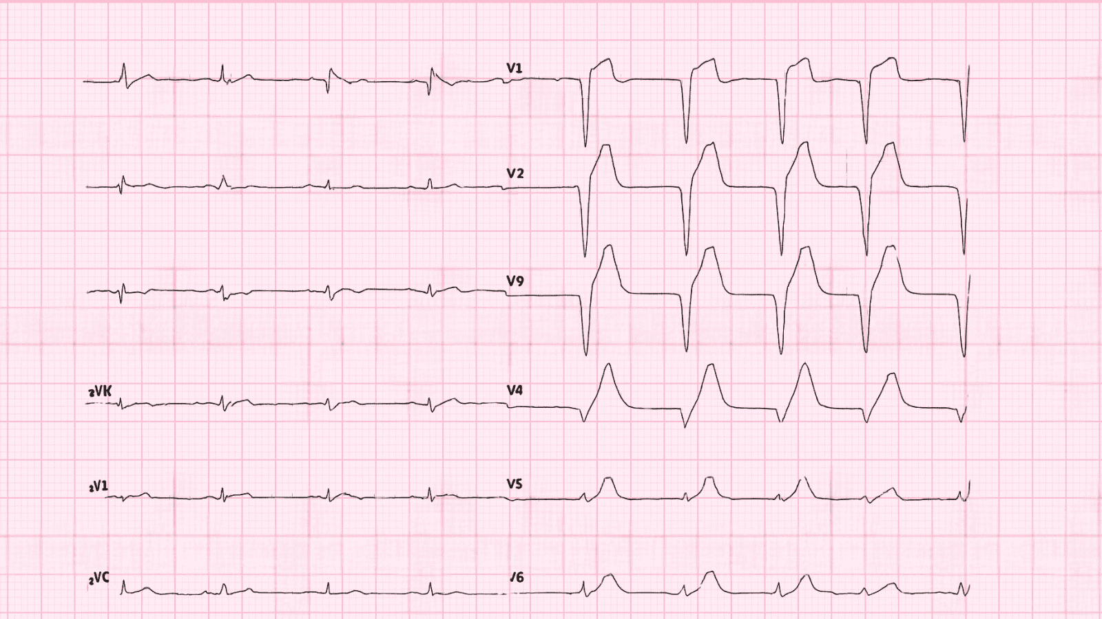 Lateral Wall Myocardial Infarction: Advanced ECG Recognition and Emergency Management