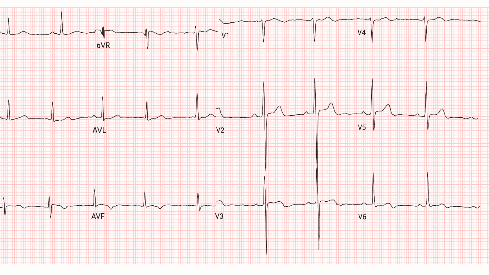 Long QT Syndrome: Advanced ECG Recognition and Emergency Management