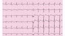 Right Bundle Branch Block (RBBB): Advanced ECG Recognition and Emergency Management