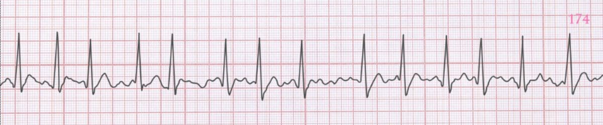Atrial Fibrillation (AFib): Recognition and Clinical Significance