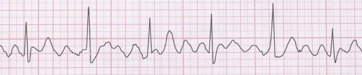 Atrial Flutter: ECG Recognition and Clinical Management