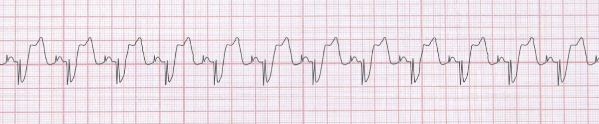 Dual Chamber Paced Rhythm: ECG Recognition and Clinical Management