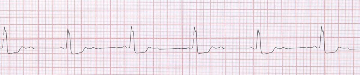 Second Degree AV Block Mobitz Type I: ECG Recognition and Clinical Management