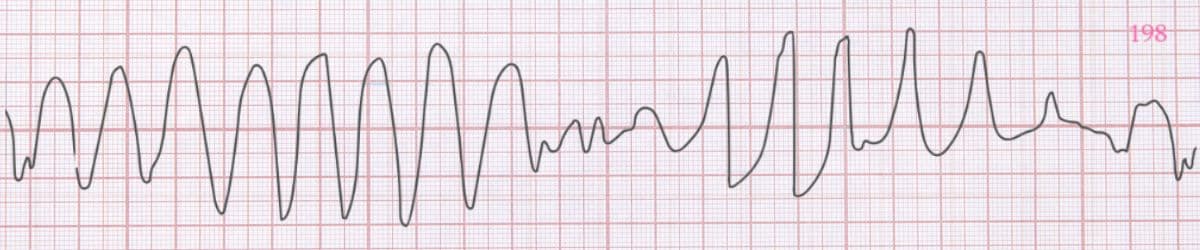 Torsades de Pointes: ECG Recognition and Emergency Management