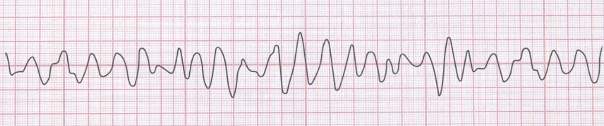 Ventricular Fibrillation: ECG Recognition and Clinical Management