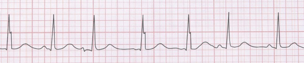Wandering Atrial Pacemaker: ECG Recognition and Clinical Management