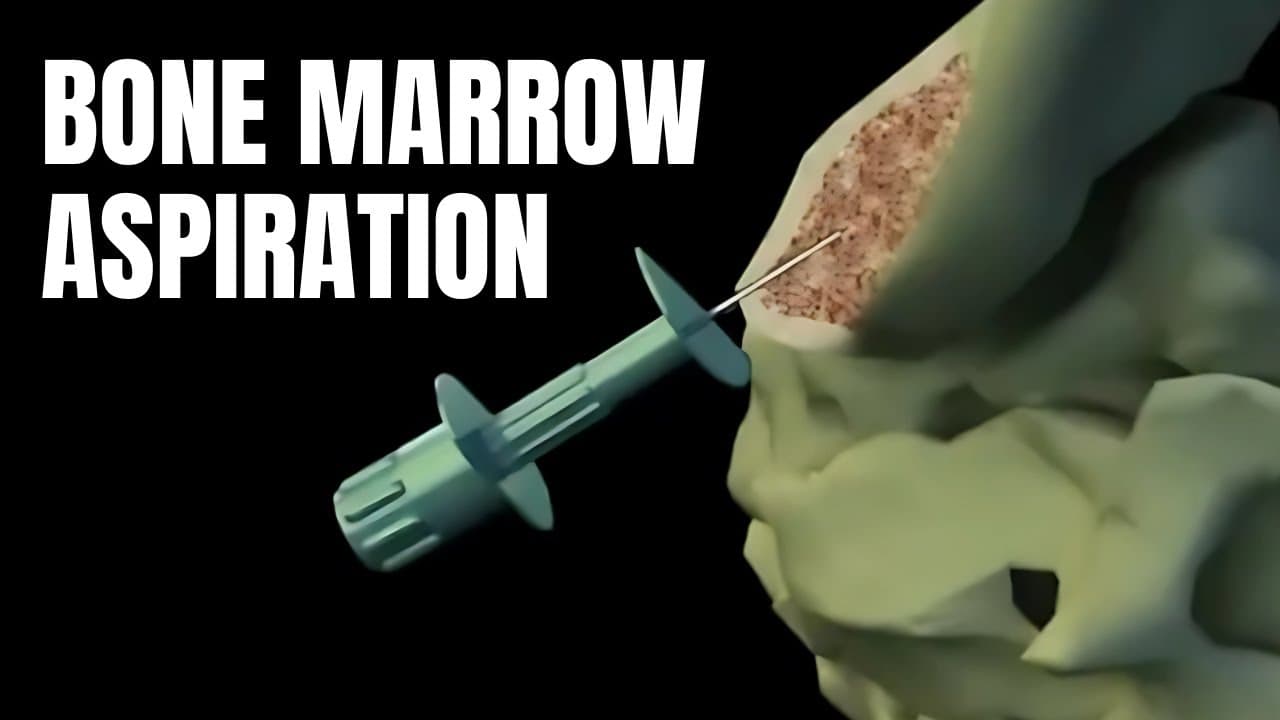 Bone marrow Aspiration and Biopsy Procedure explained