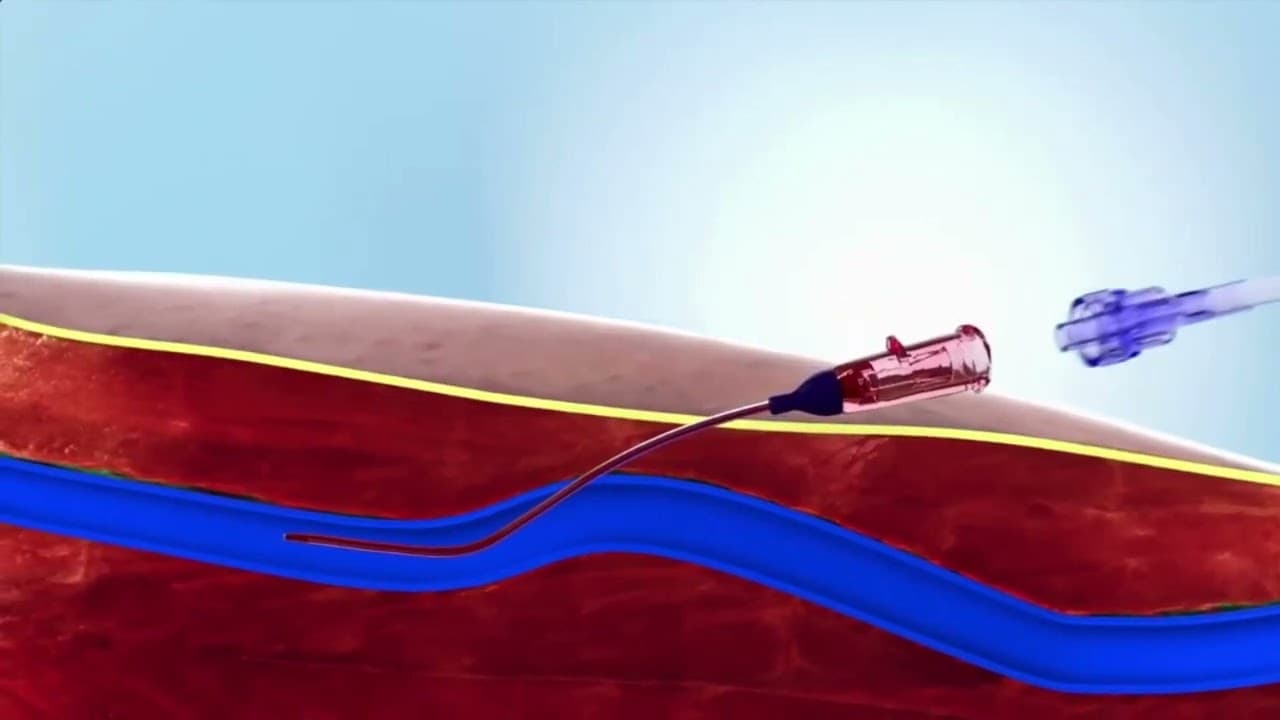 Peripheral IV catheter insertion (Medical Animation)