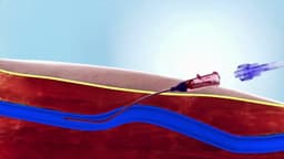 Peripheral IV catheter insertion (Medical Animation)