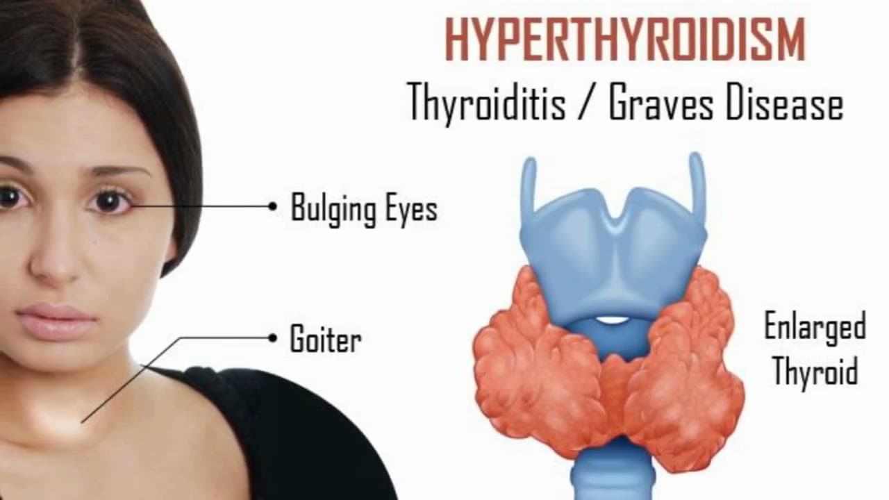 clinical case presentation: Hyperthyroidism or Graves disease