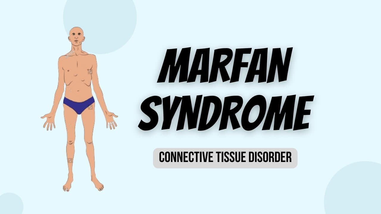 Marfan Syndrome (MFS) : Disorder of connective tissue