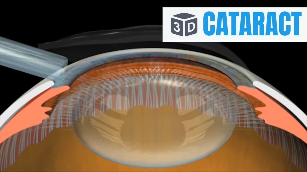 Cataract: causes, types & Surgery