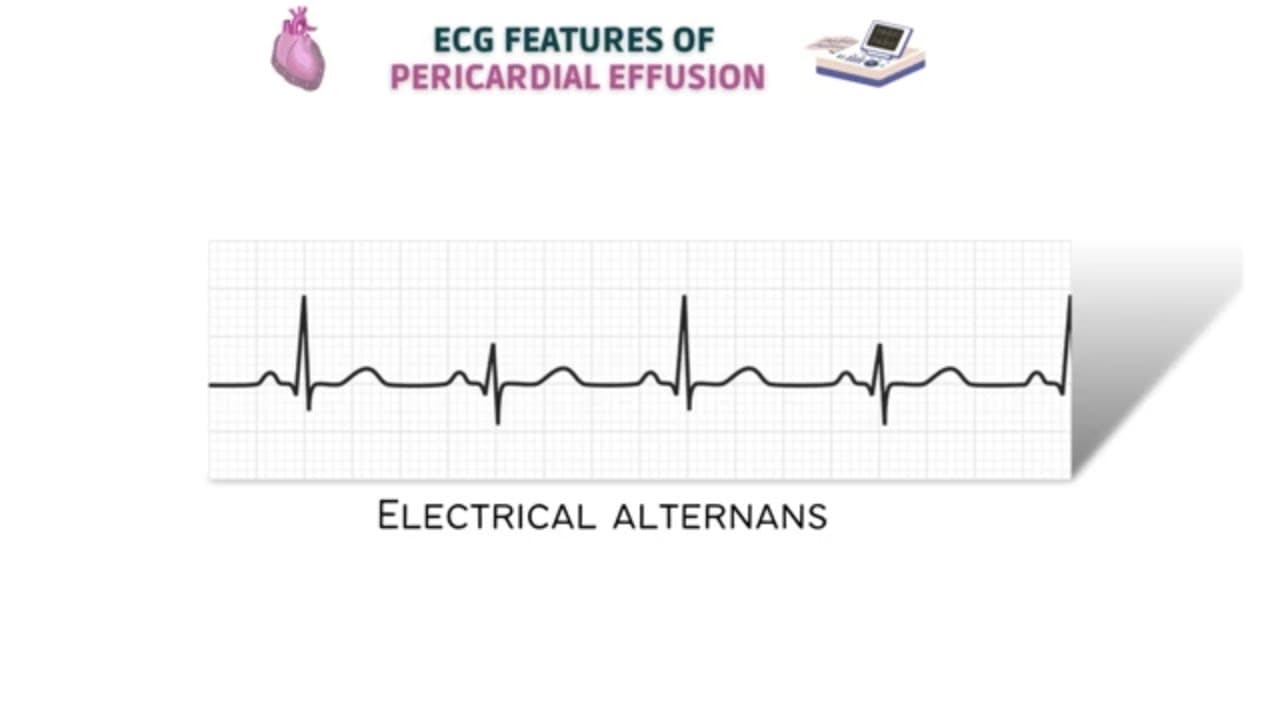 Ecg features of pericardial effusion & electrical alternans