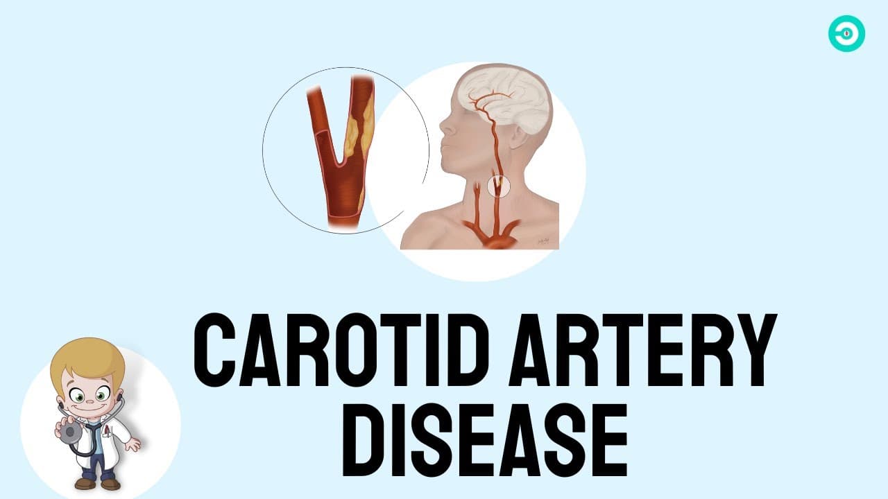 Carotid Artery Disease & carotid stent