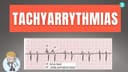 How to dignose Abnormal heart rhythm (Tachyarrythmias) On ECG : Step by step