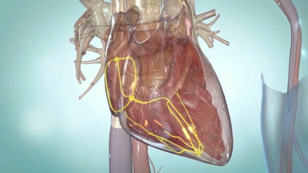 Premature Ventricular contraction (PVCs)