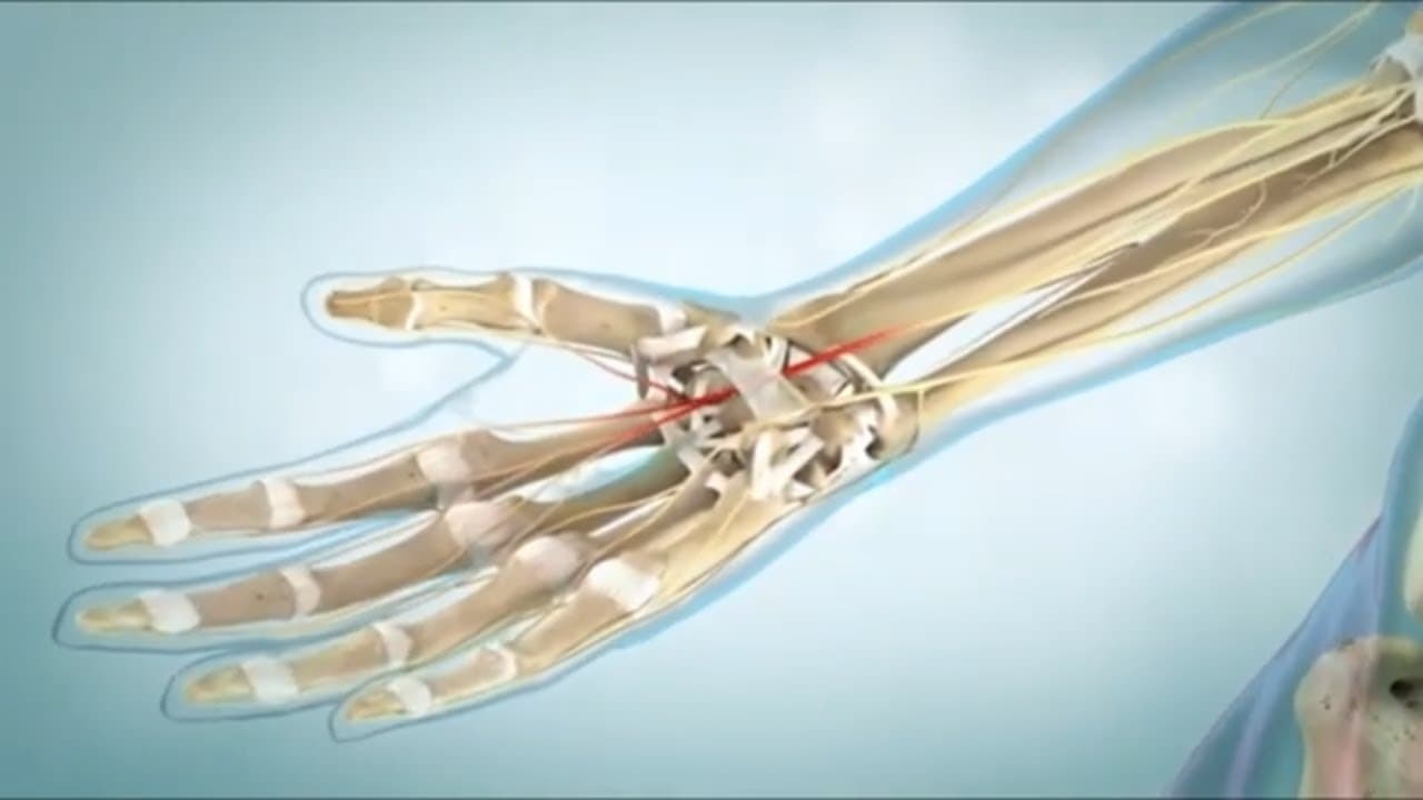 What is carpel tunnel syndrome? and treatment with surgery