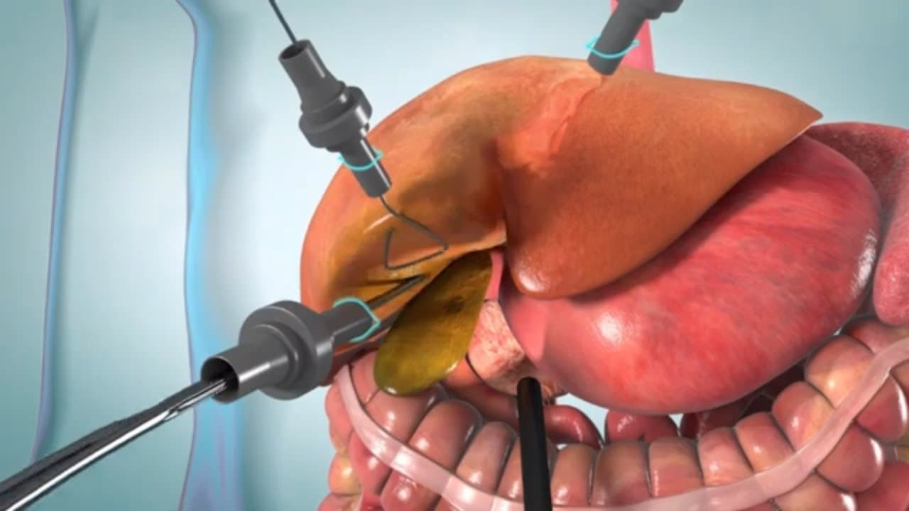 Laparoscopic and open cholecystectomy surgery (animation)
