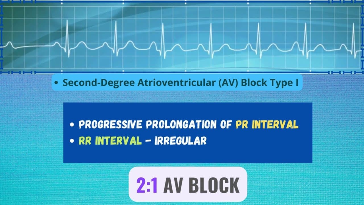 AV Block: ECG features and Comparison with ECG simulator