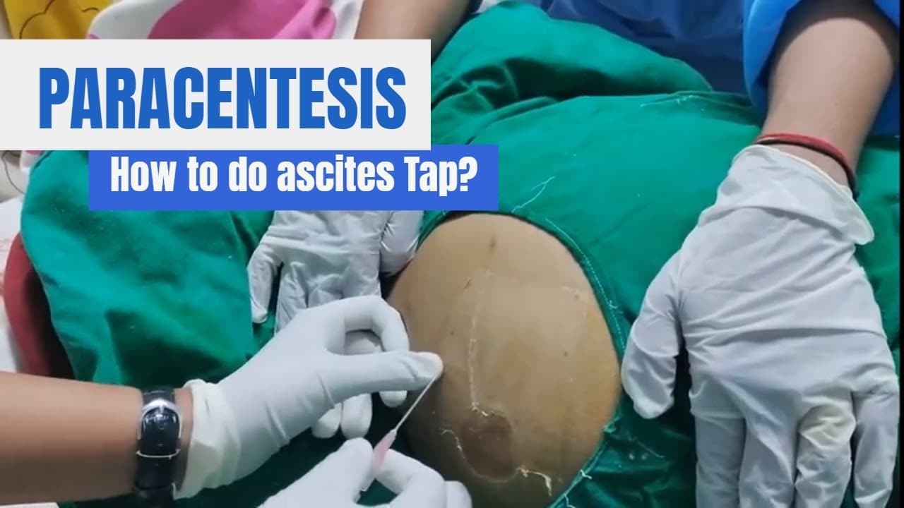 #Paracentesis Procedure: #Ascites #Tap in detail