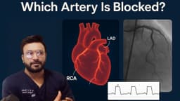 From ECG to Angiography: How to Identify Which Artery Is Blocked