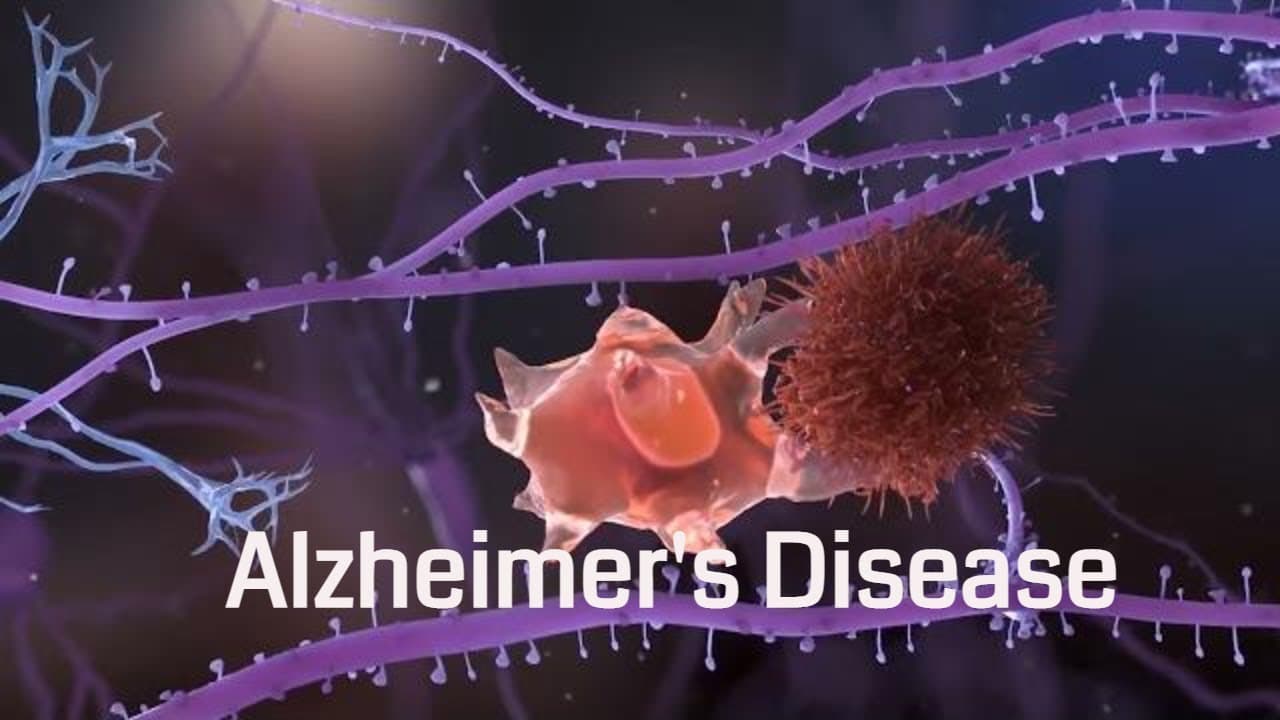 Alzheimer's disease: Pathophysiology and causes