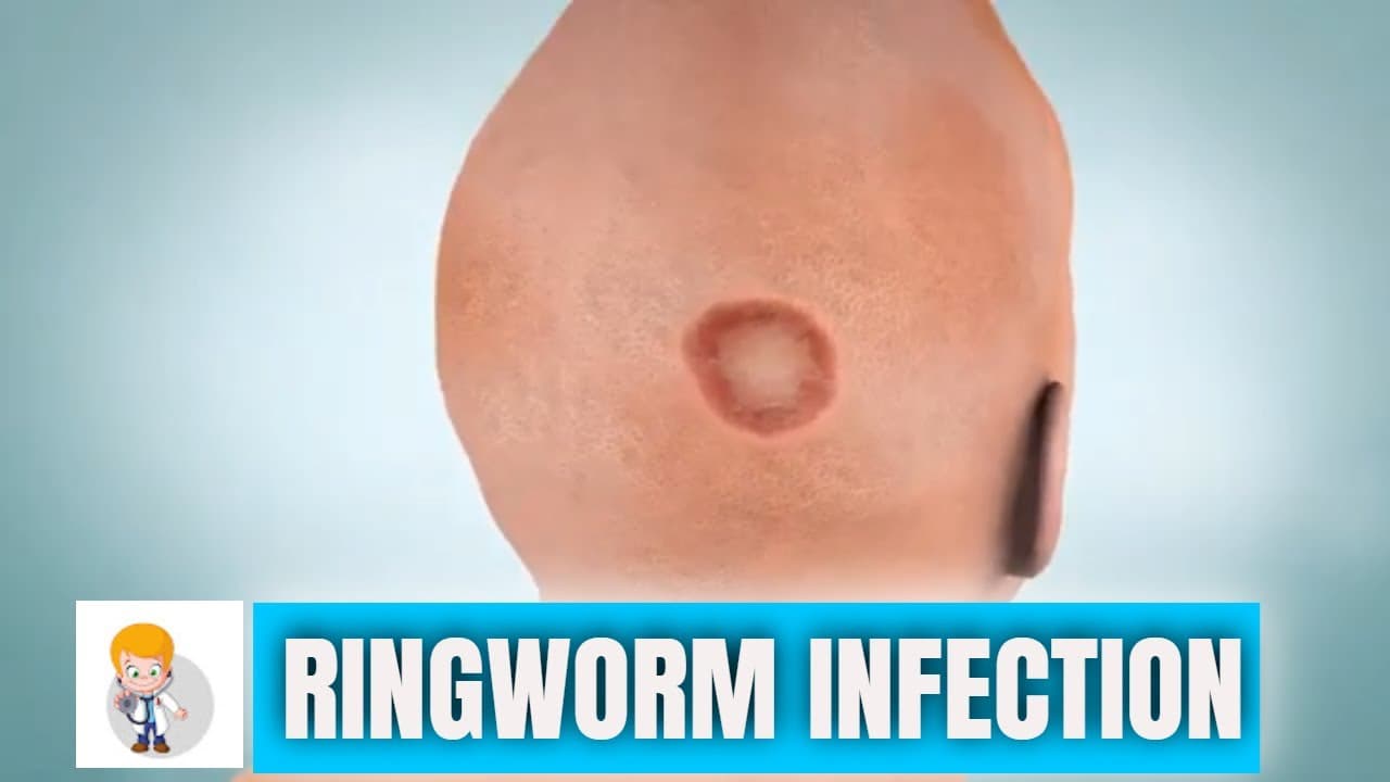Ringworm : Types, Symptoms and Treatment of Fungal infection of Skin