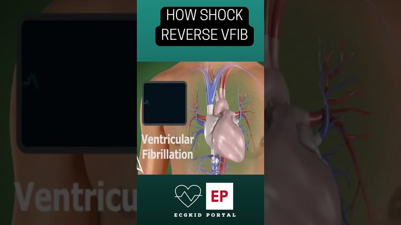 How #shock reverse #Vfib in emergency room