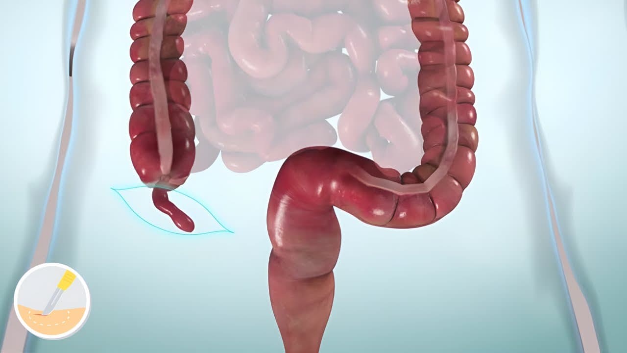 Laparoscopic & Open Appendectomy procedures: Medical animation