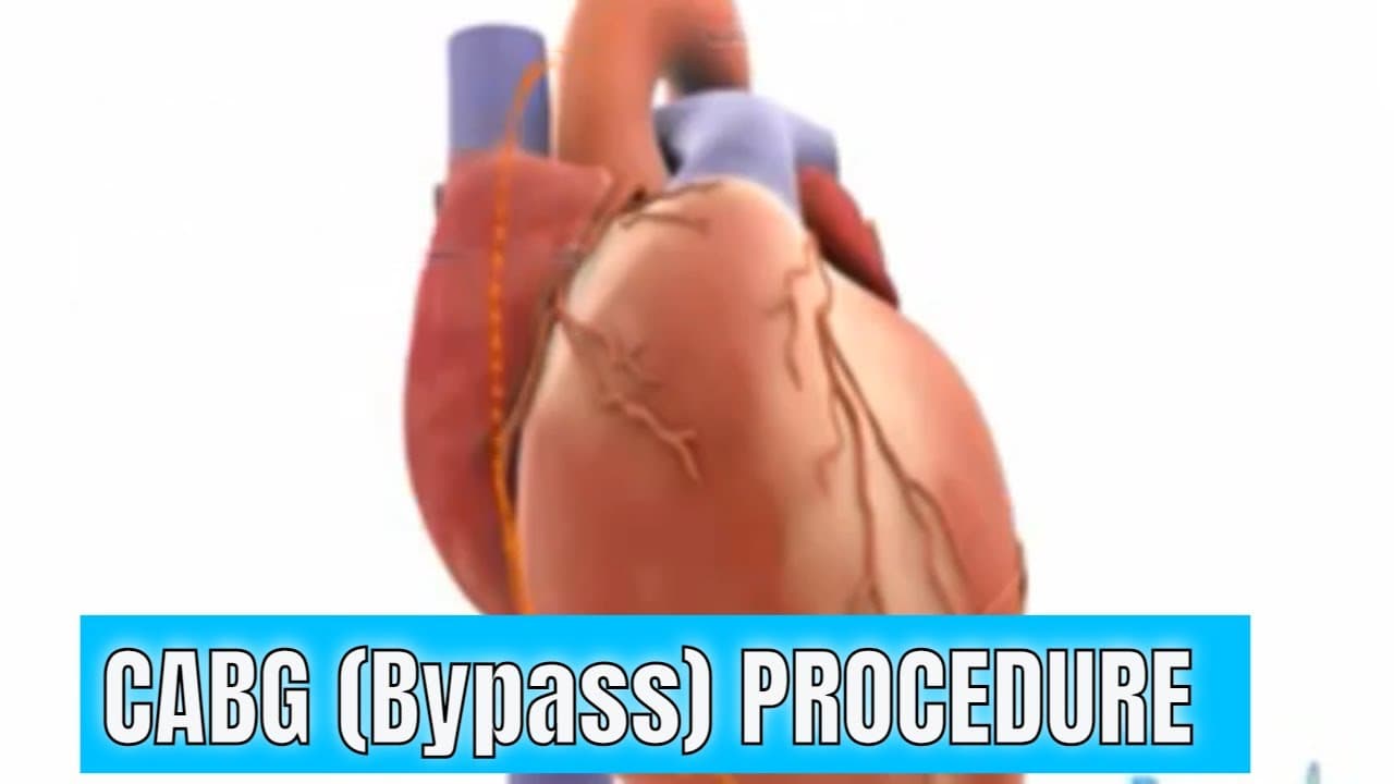 CABG (Coronary artery bypass graft) surgery explained
