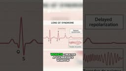 Sudden Cardiac Death in Athletes ⚡️ | 5 ECG Patterns You Must Know #doctorexplains