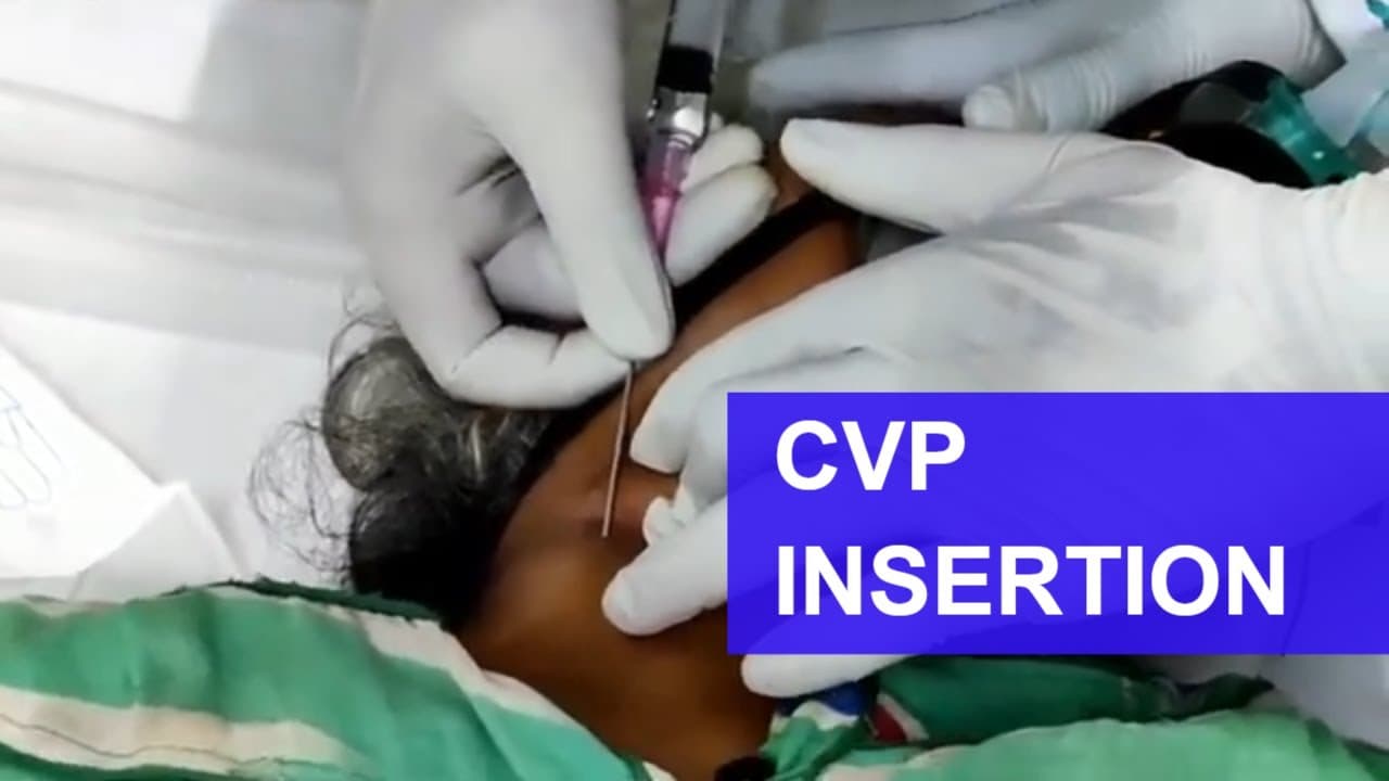 #CVP insertion (right #IJV) #central line insertion