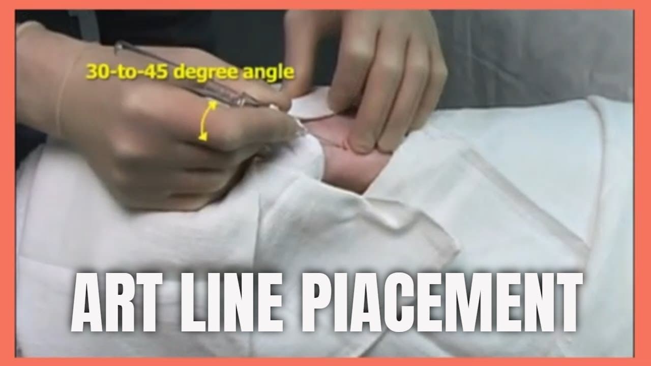 Arterial Line placement For monitoring arterial Blood pressure