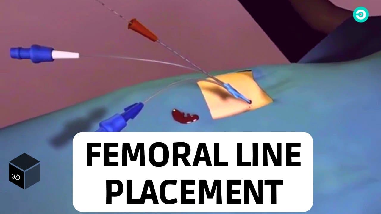 Central Line placement (Femoral Vein): Medical animation